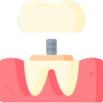  Dental Implants